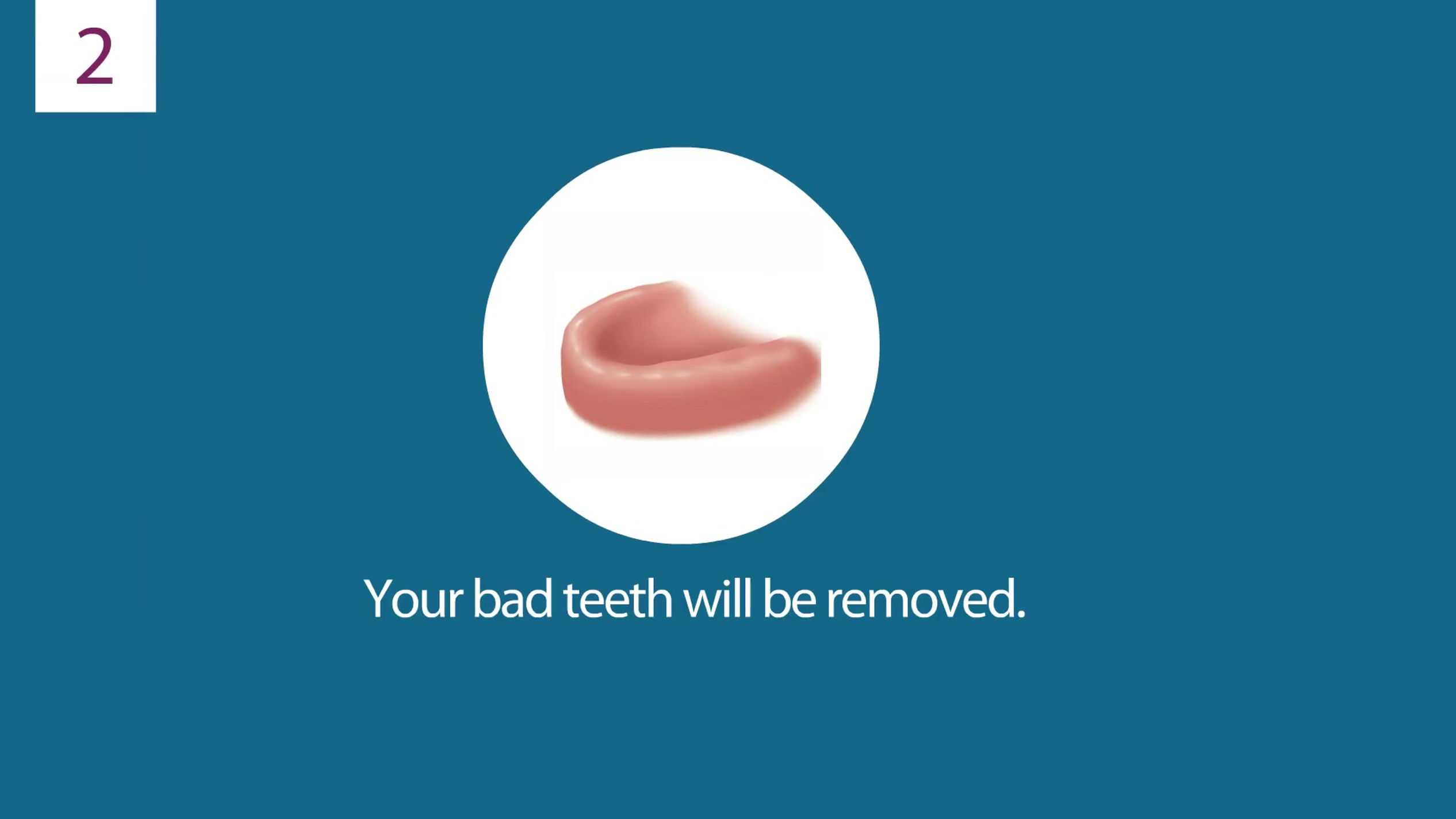 dental_implants_for_terminal_dentition_2021_HD